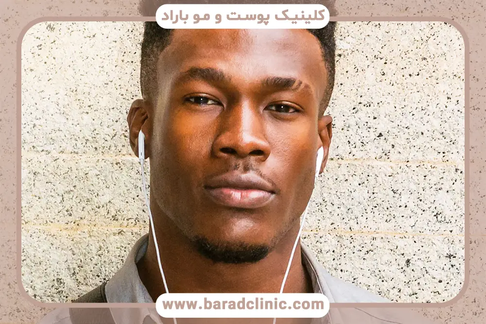 مراقبتهای قبل و بعد کاشت ریش چانه