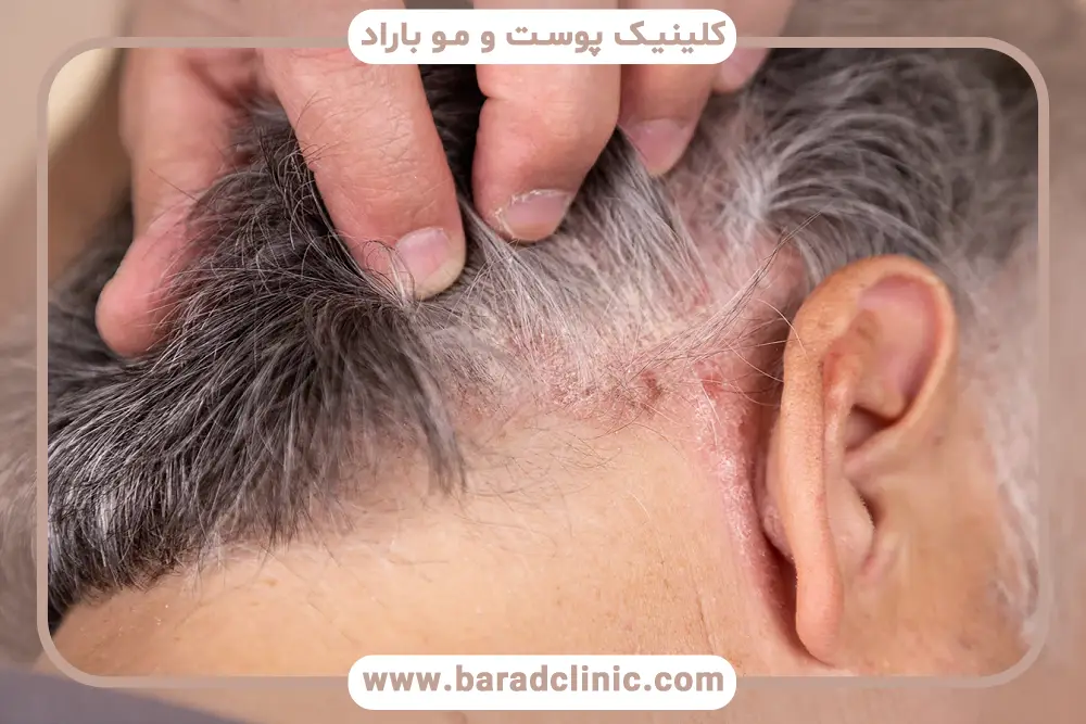 راهکارهای خانگی درمان خارش سر بعد از کاشت مو