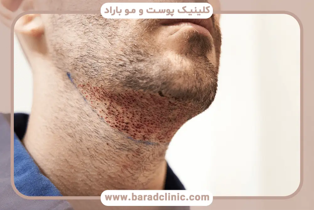 مراقبت‌های قبل و بعد کاشت تخصصی ریش