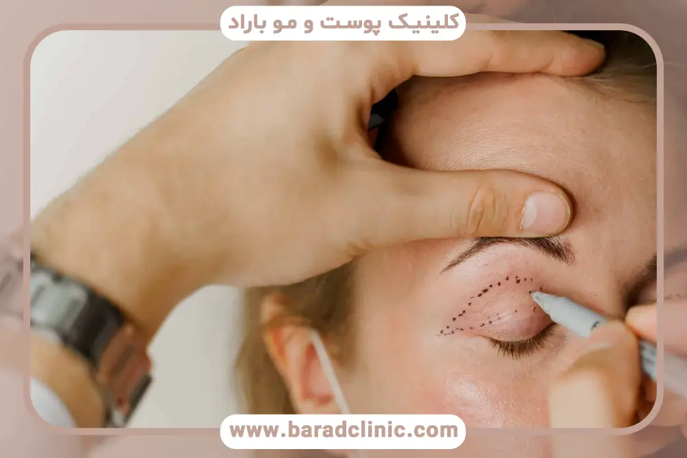 مراقبتهای بعد از بلفاروپلاستی