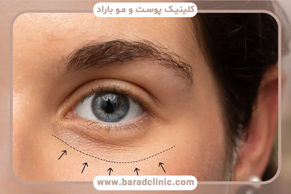 مراقبت‌های بعد از بلفاروپلاستی ترمیمی 