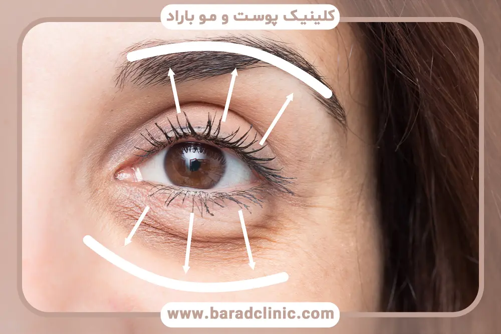 عوارض جانبی بلفاروپلاستی ترانس کونژ