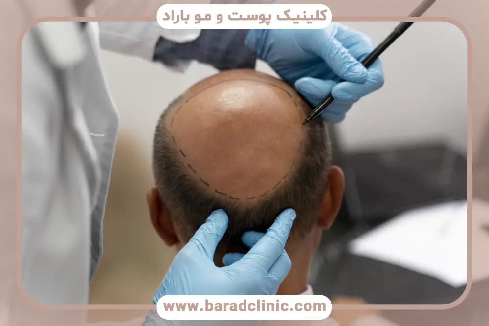 بررسی تراکم و خط رویش در تصاویر کاشت مو