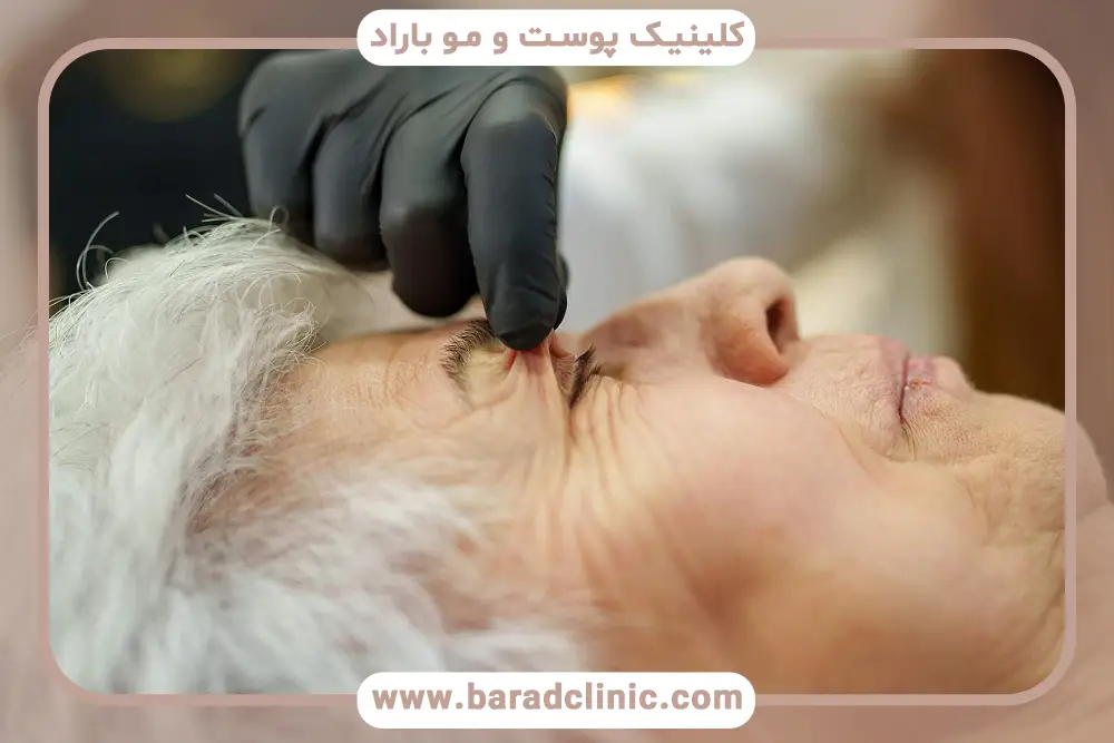 تاثیر مراقبت‌های بعد از عمل روی ماندگاری بلفاروپلاستی