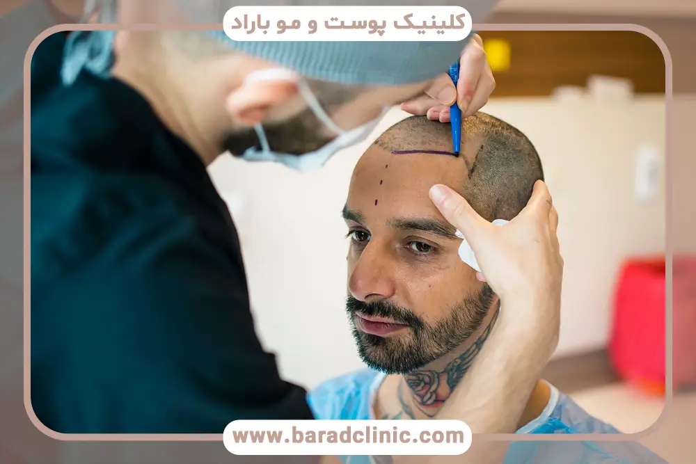 کاشت مو چند ساعت طول میکشد؟ تاثیر سن و شرایط جسمانی