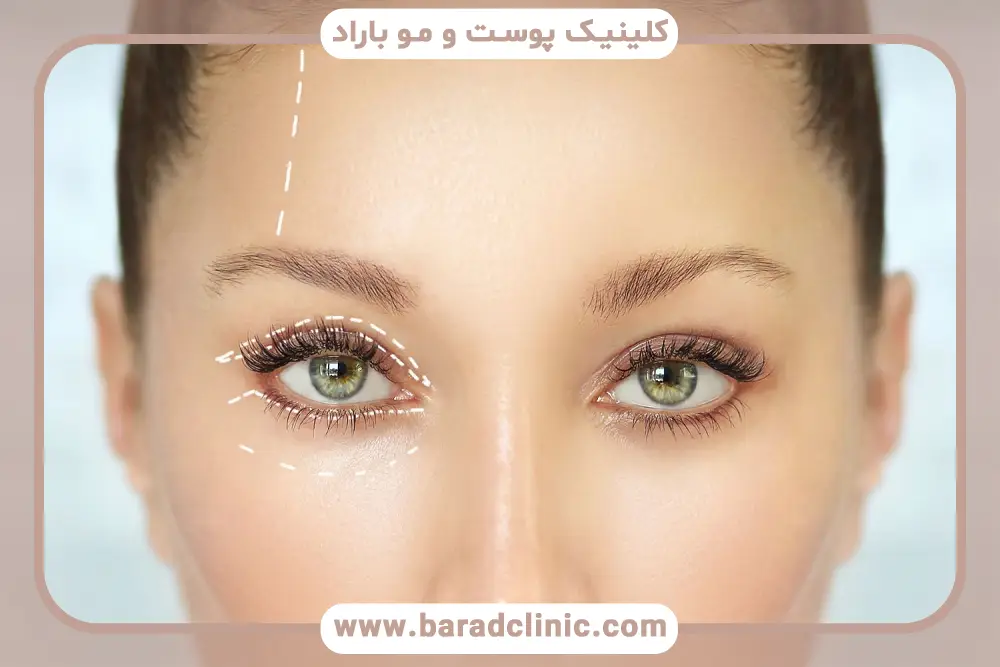 عوامل موثر بر هزینه بلفاروپلاستی اقساطی