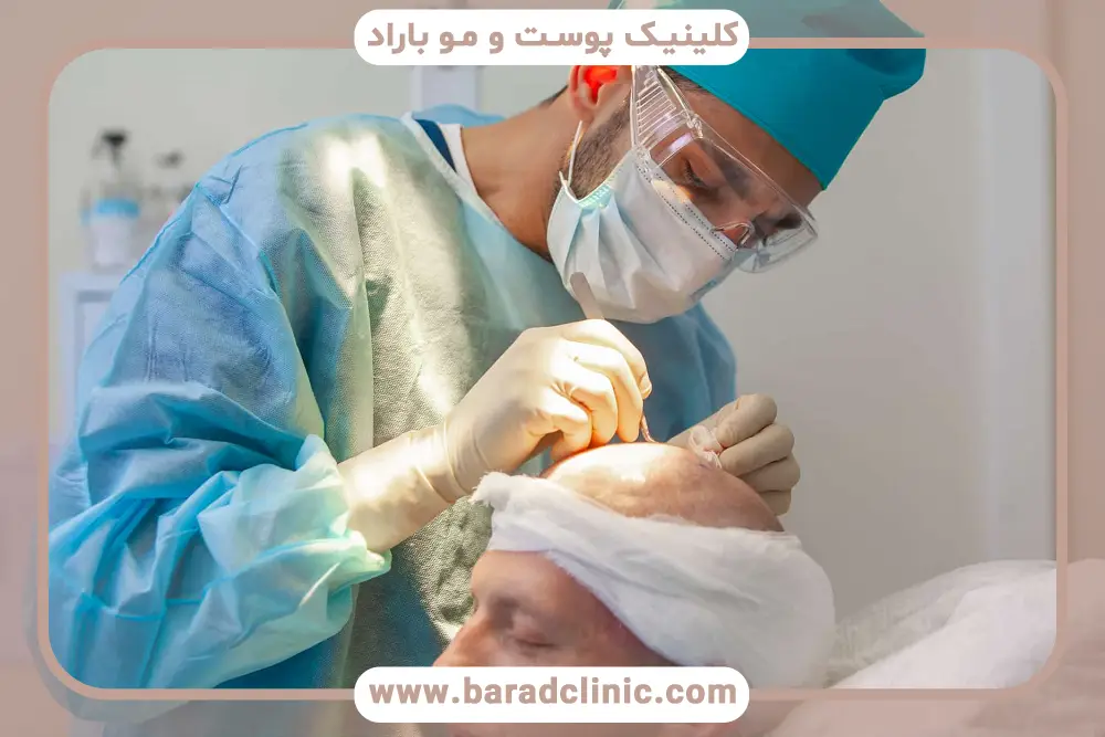 سرعت بالای کاشت مو به روش dhi