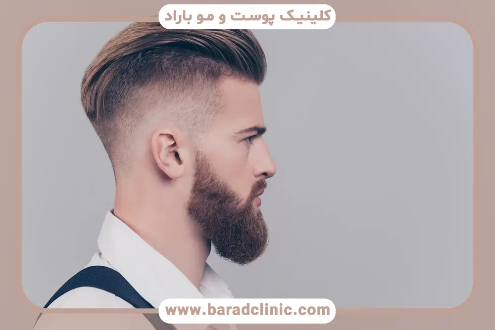 عوامل موثر بر انتخاب مدل کاشت ریش مردانه