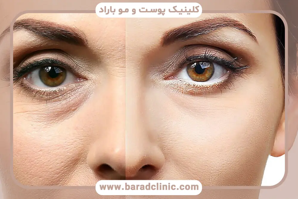 تاثیر مراقبتهای بعد از عمل روی نتایج عکس بلافاصله بعد از عمل بلفاروپلاستی