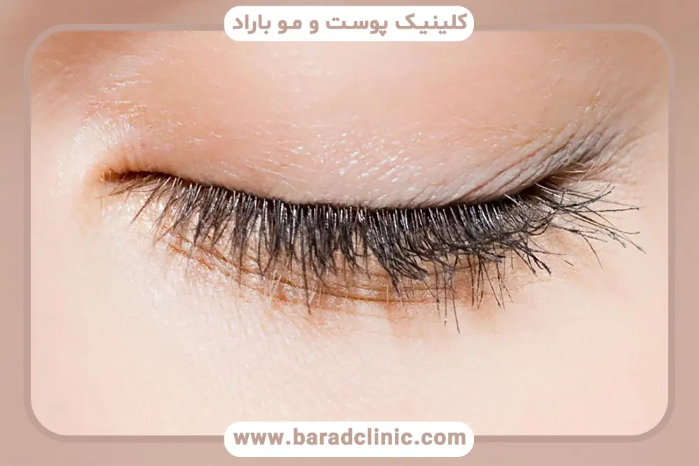 راهکارهای کاهش احساس کشیدگی پلک بعد از بلفاروپلاستی