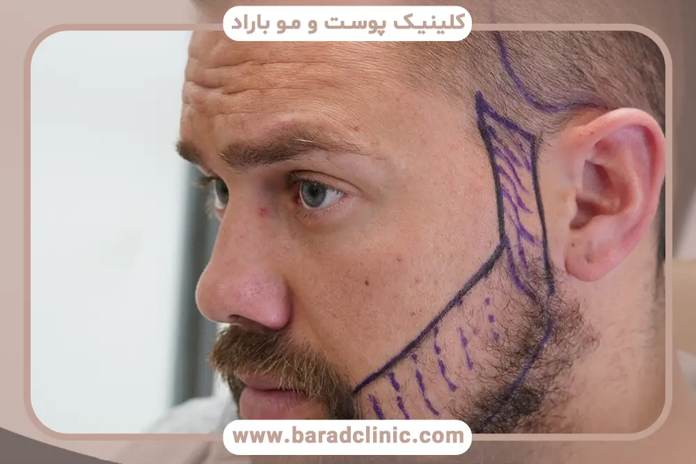 هزینه جدیدترین روش کاشت ریش