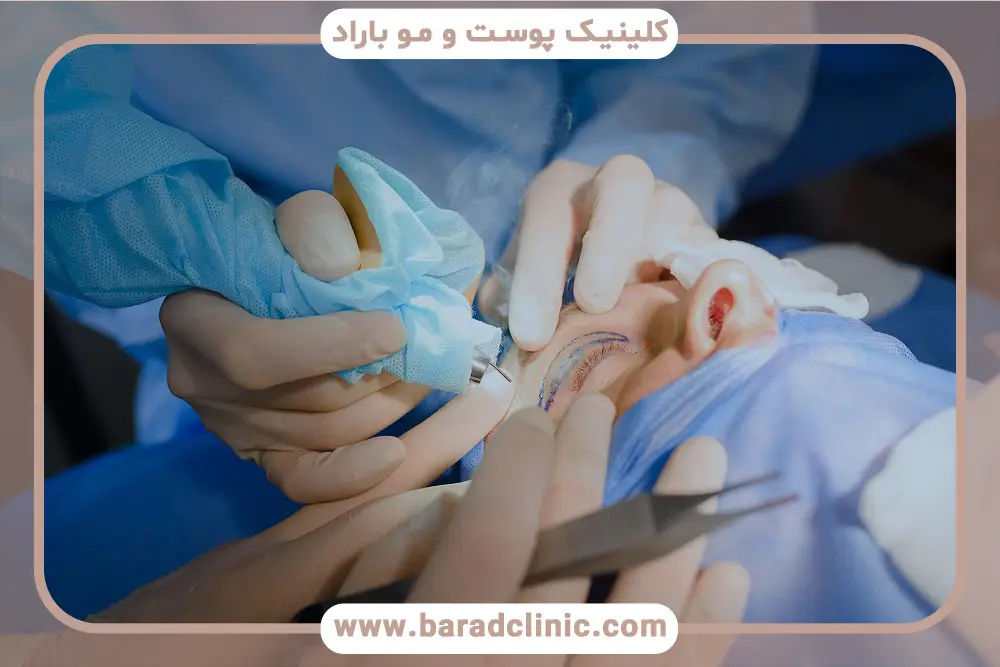 مراقبتهای بعد از بلفاروپلاستی پلک بالا با لیزر