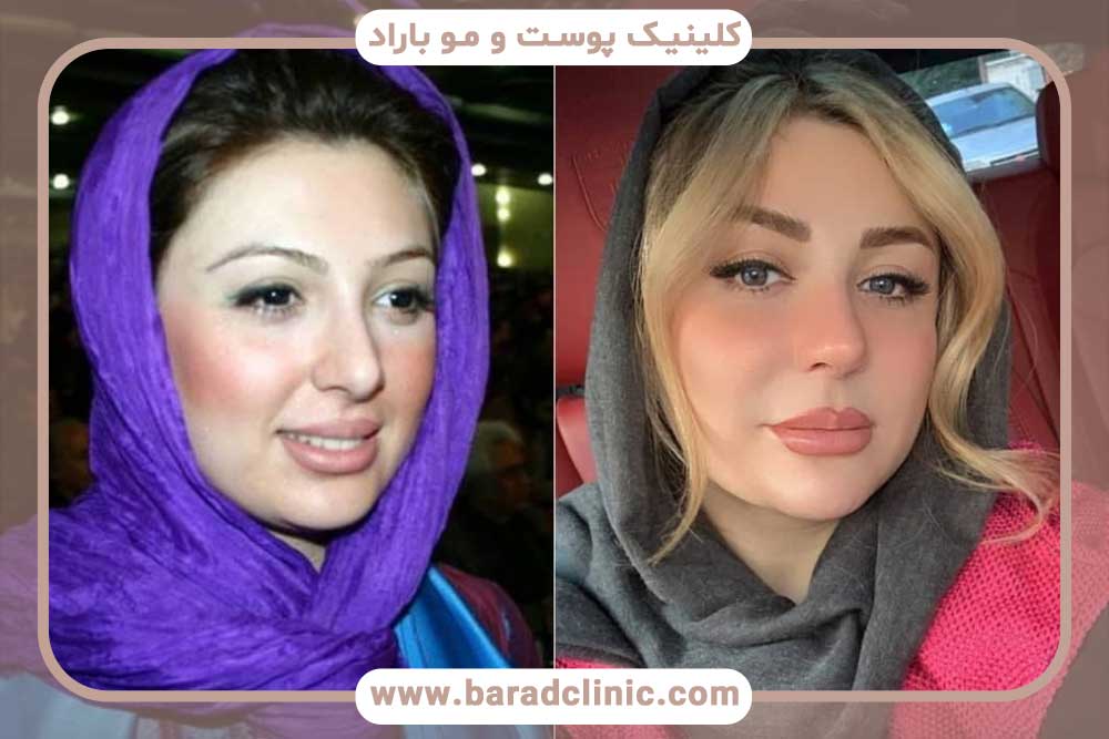 کاشت ابرو بازیگران