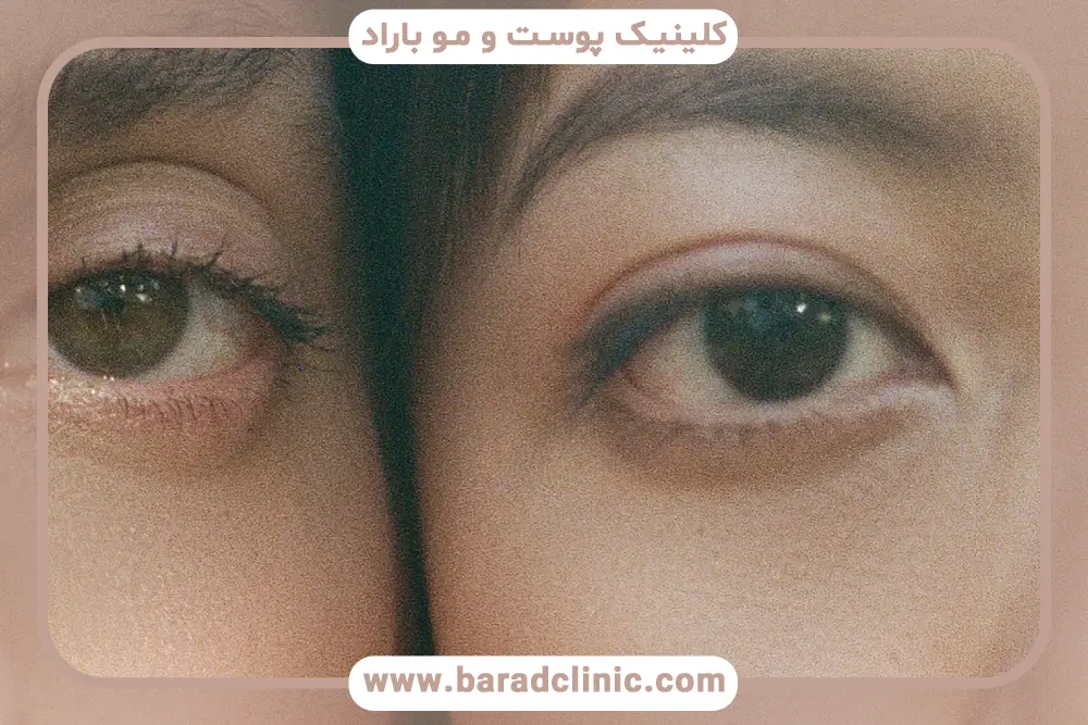 مراقبت‌های بعد از بلفاروپلاستی چشم 