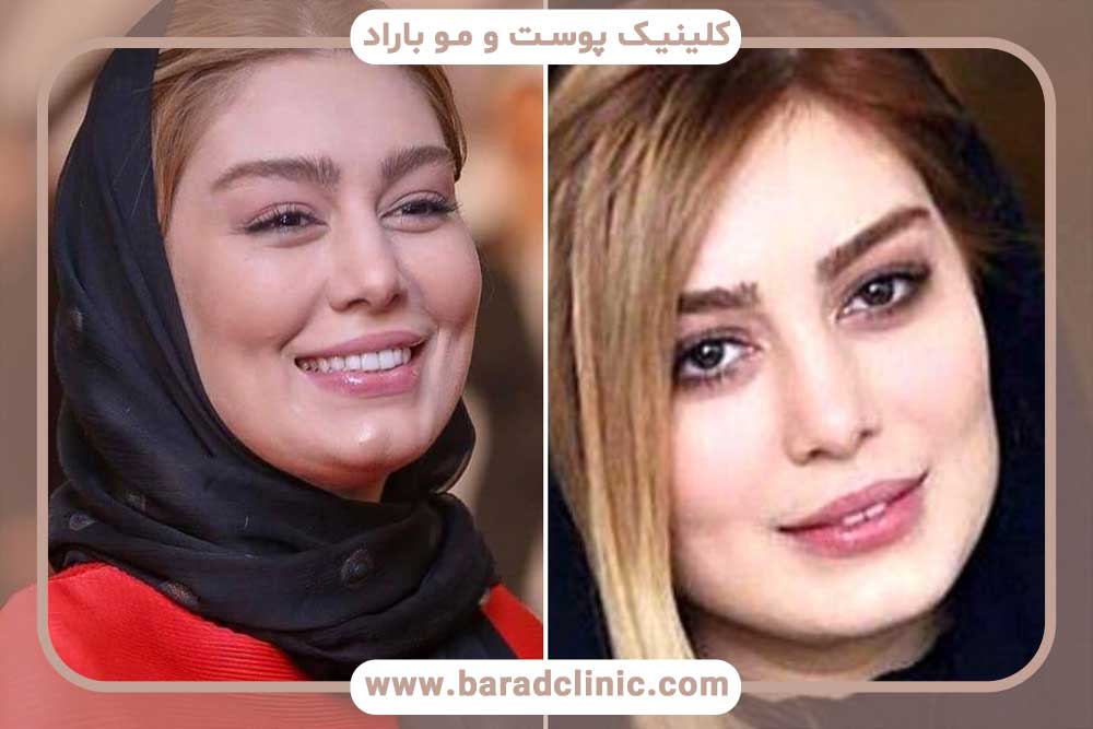 کاشت ابرو بازیگران