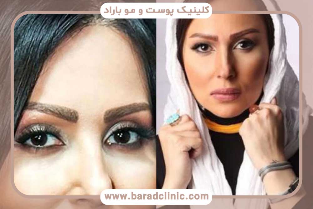 کاشت ابرو بازیگران