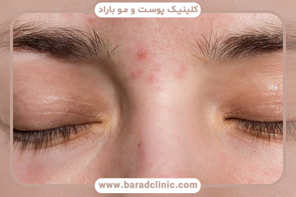 جوش بعد از کاشت ابرو