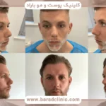 نمونه کاشت ریش