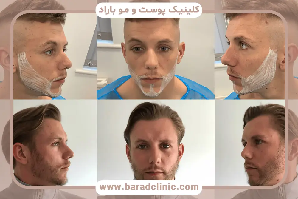 نمونه کاشت ریش