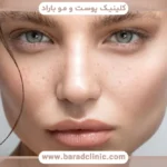 بلفاروپلاستی چشم روباهی