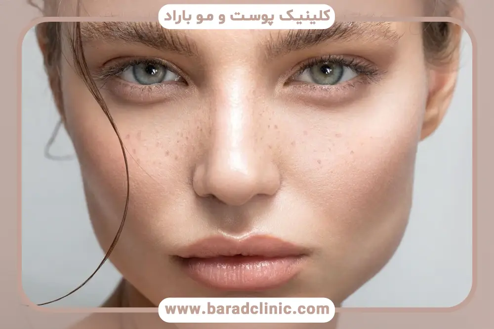 بلفاروپلاستی چشم روباهی