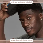 تبلیغات کاشت مو