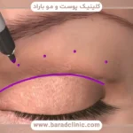 فیلم عمل بلفاروپلاستی با لیزر