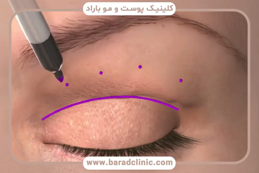 فیلم عمل بلفاروپلاستی با لیزر