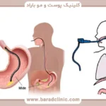 بوتاکس معده چیست