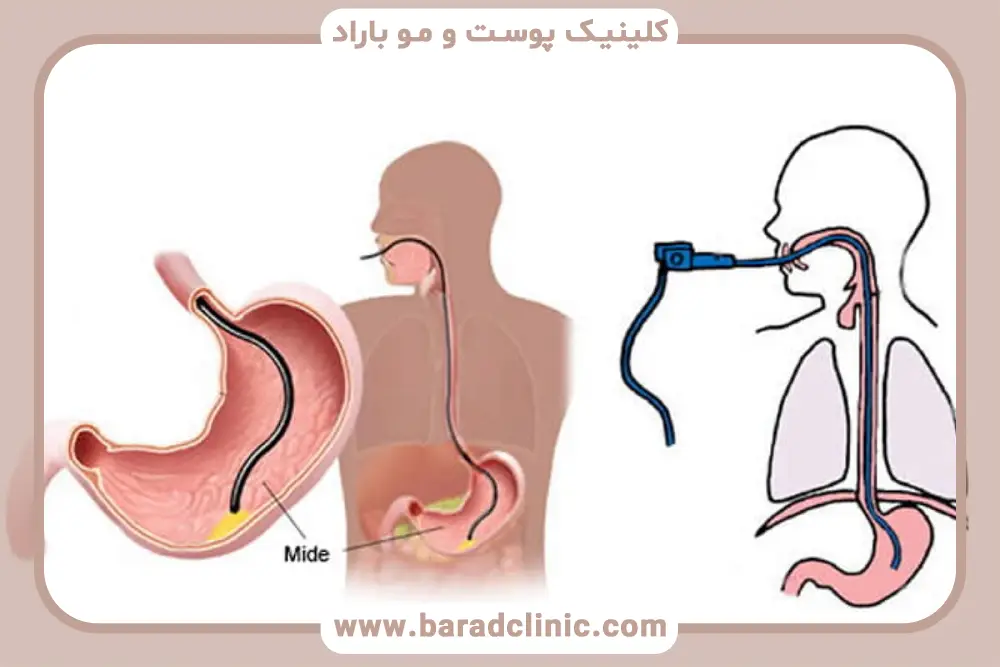 بوتاکس معده چیست