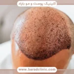 نتیجه کاشت مو بعد از چند ماه مشخص میشود