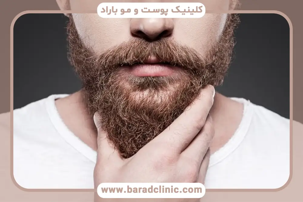 کاشت ریش قیمت