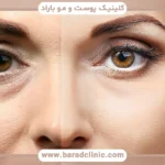 ایا بلفاروپلاستی دائمی است