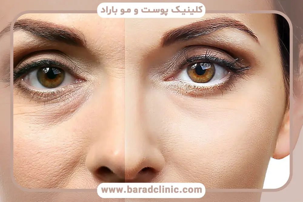 ایا بلفاروپلاستی دائمی است