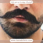 عمل کاشت ریش
