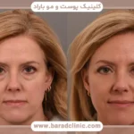 هزینه عمل بلفاروپلاستی