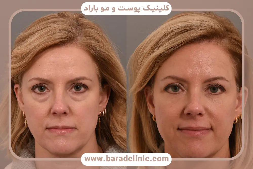 هزینه عمل بلفاروپلاستی