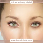 عوارض بلفاروپلاستی پلک بالا