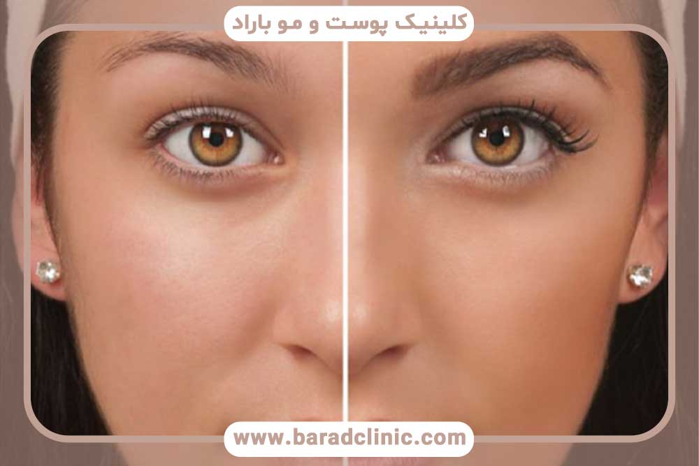 کاشت ابرو طبیعی در تهران