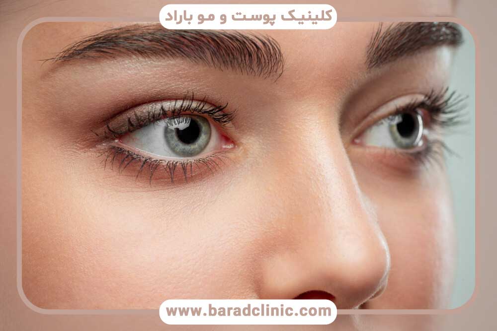 برداشت فلپ در کاشت ابرو