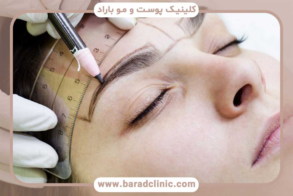 روش فلپ در کاشت ابرو