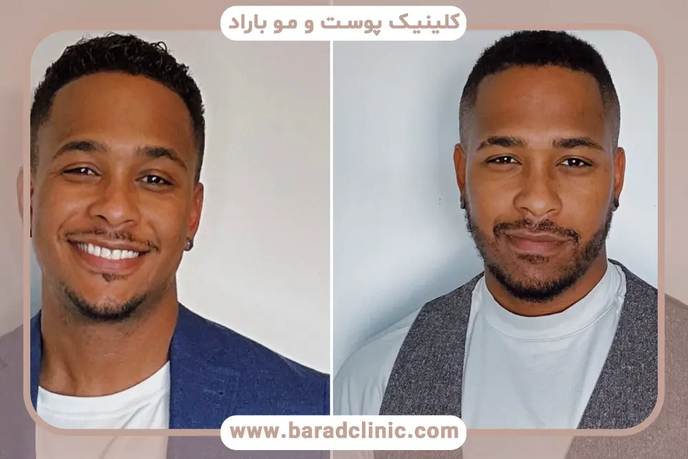 ریش کاشت شده