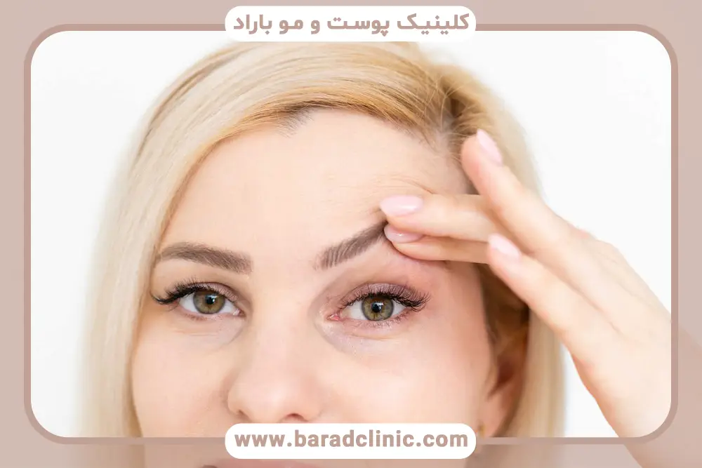 نتیجه نهایی عمل بلفاروپلاستی