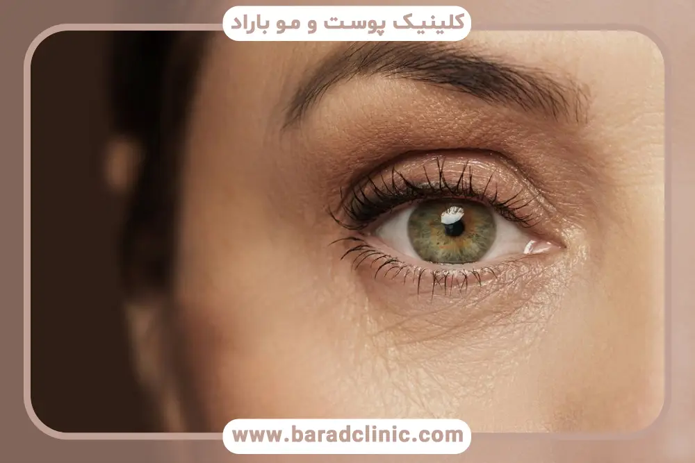 بهترین مرکز بلفاروپلاستی در تهران