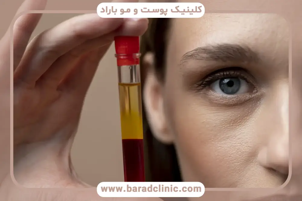 مقایسه prp و prf