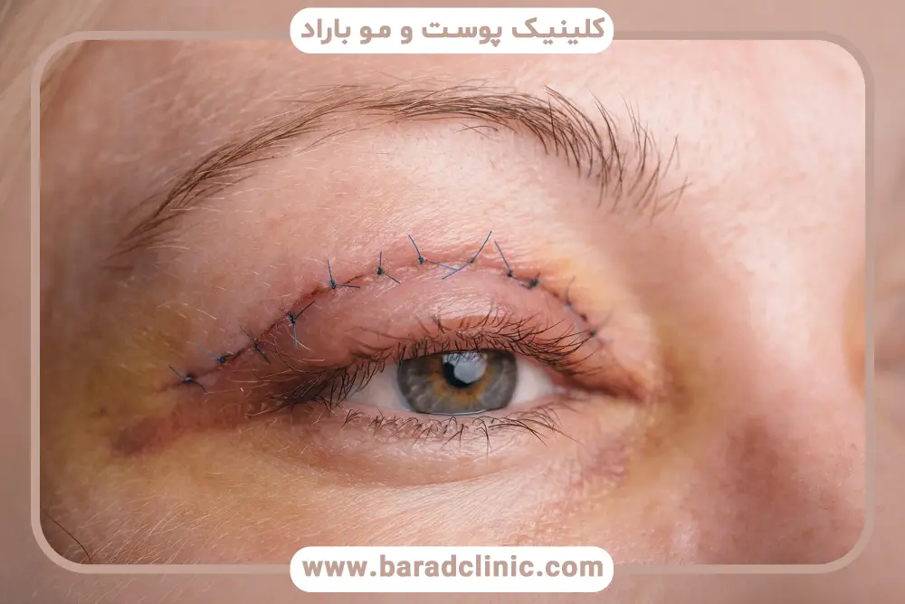 اسکار بلفاروپلاستی