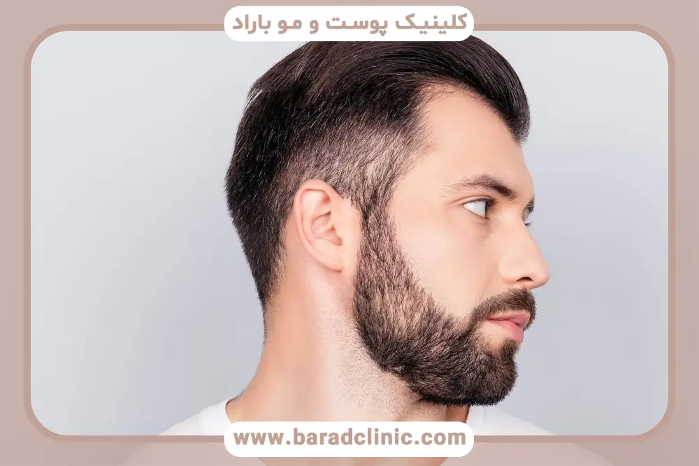 کاشت ریش در صورت