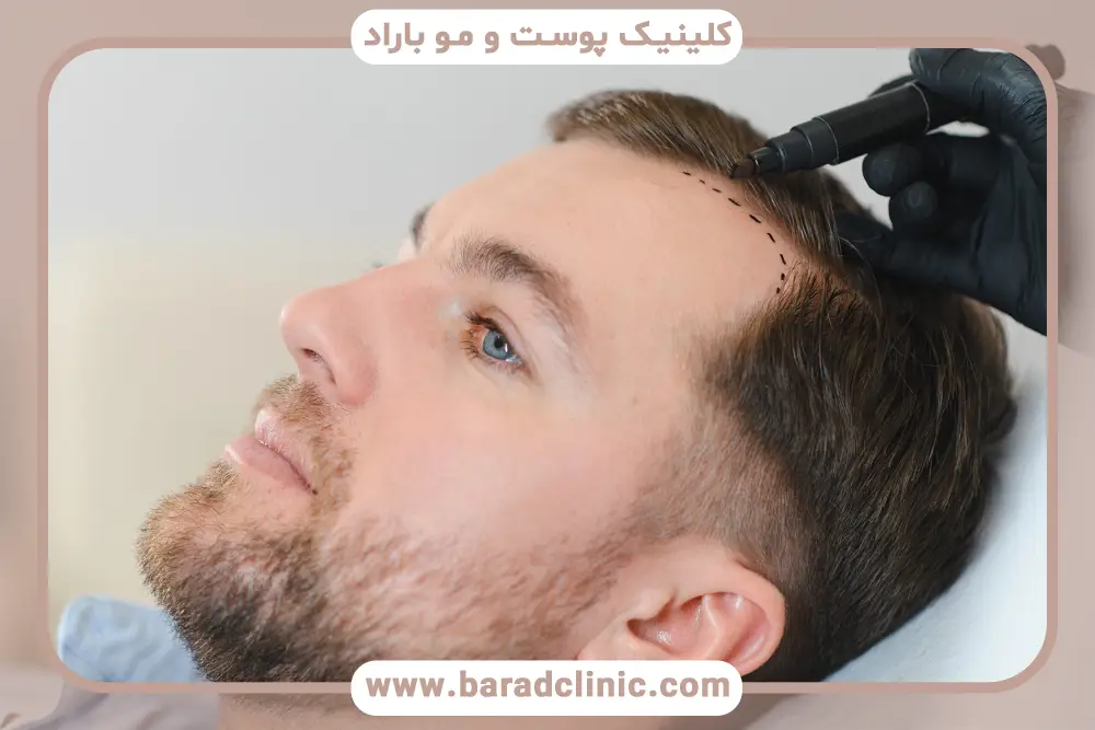 کلینیک کاشت مو در تهران