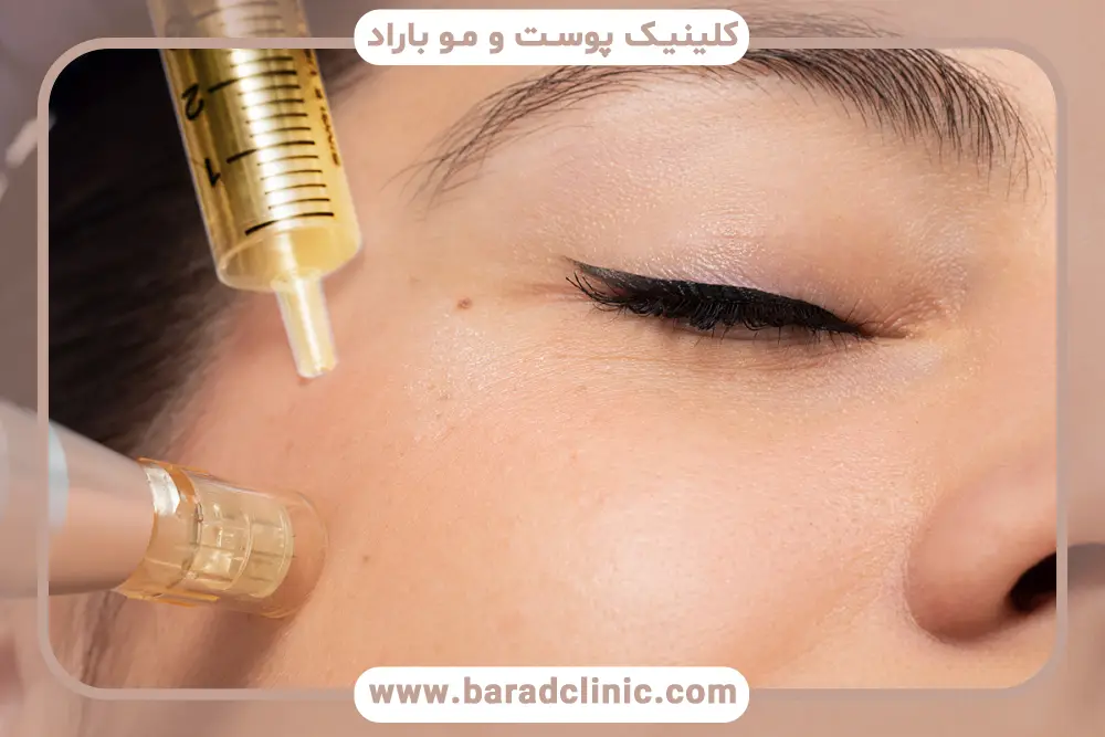 prp  مو چگونه انجام میشود