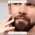 نحوه کاشت ریش